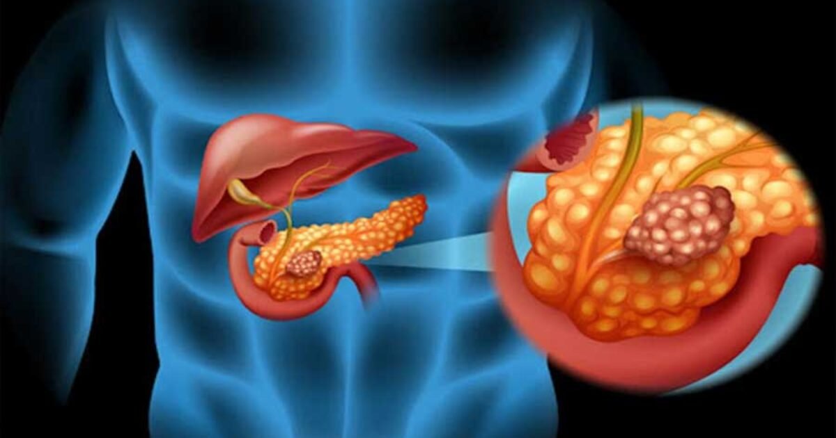 صورة مميزة: إدارة الغذاء والدواء توافق على علاج مستهدف لسرطان البنكرياس