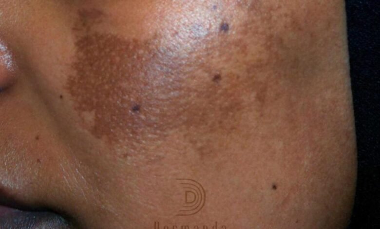 Dermanda Clinic إسم رائد في علاج الكلف بمختلف أنواعه