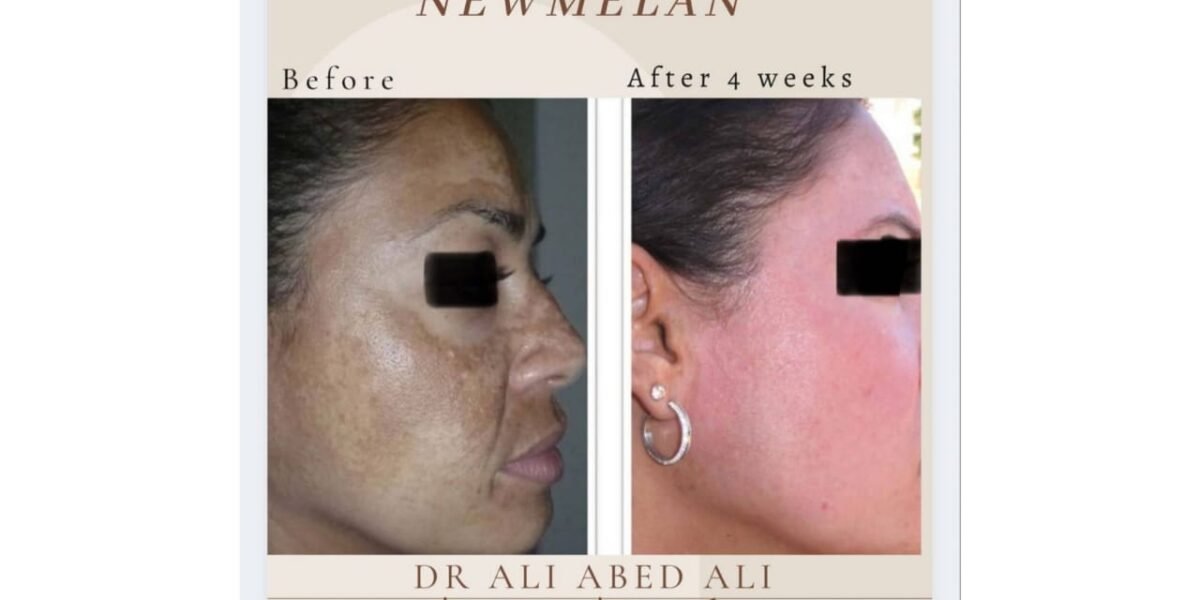 newmelan pigmentation الحل الأنسب لمعالجة تصبّغات الوجه مدى الحياة حديث مع دكتور التجميل ali abedali